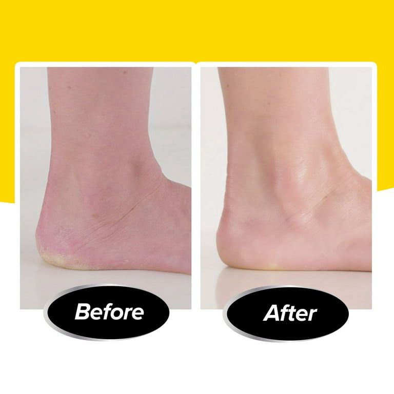 Pedi Vac Electric Foot Callus Remover with Vacuum